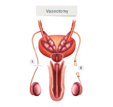 Vasektomie, Artikelbild